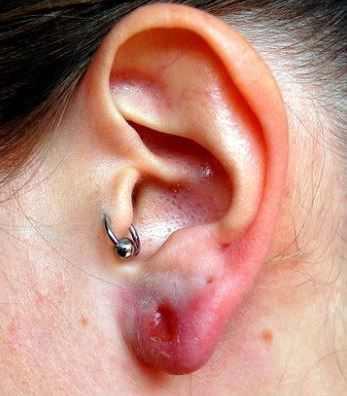 infected cartilage piercing