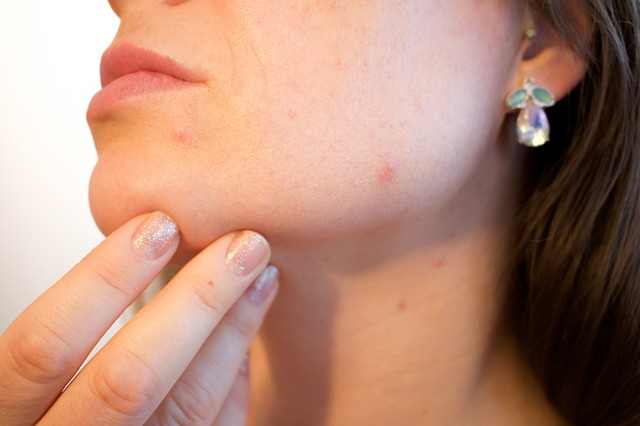 The face is the the most sensitive part when it comes to infected pore on face