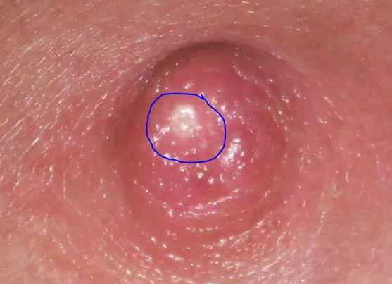 A white milk blister on areola