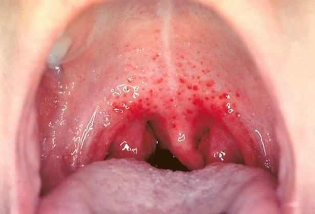 Red spots on roof of mouth