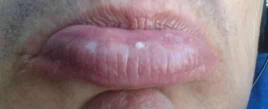 White spot on lower lip