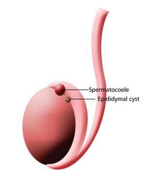 Epidydymal cyst or lump on testicles