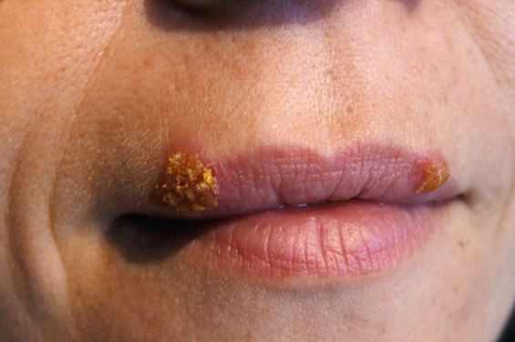 Cold sore vs. pimple on lip - cold sore crust on the upper lips
