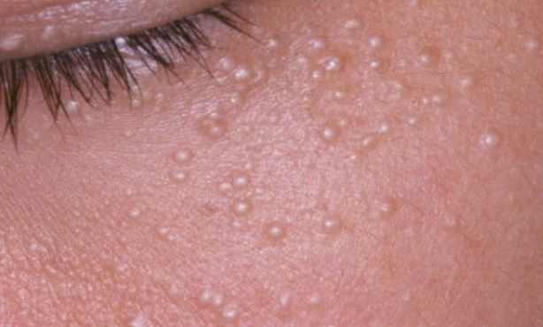 Milia spots under face skin