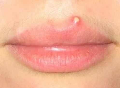 Pimple on upper lip