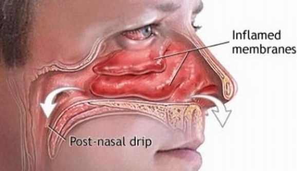 How to stop post nasal drip fast