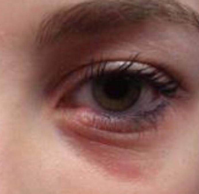 Inflammation like rings under eyes.