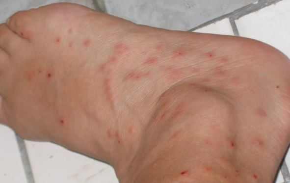 Bed bug bites on legs can make you itch at night