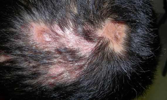 Hair loss may result from folliculitis and blocked pores