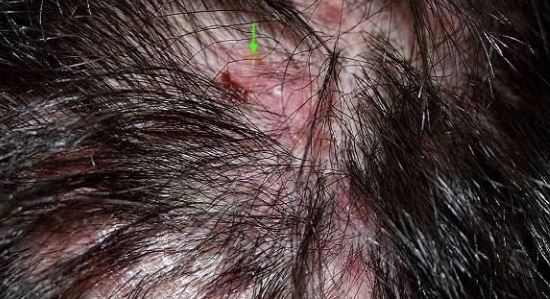 Scalp folliculitis may result from infected hair follicles