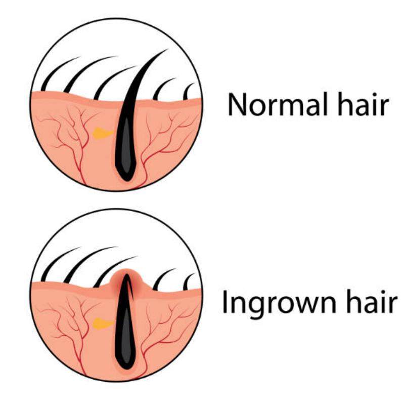normal hain vs ingrown hair, sumptoms of infection