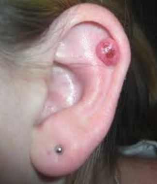 infected-cartilage-piercing-bump-on-ear