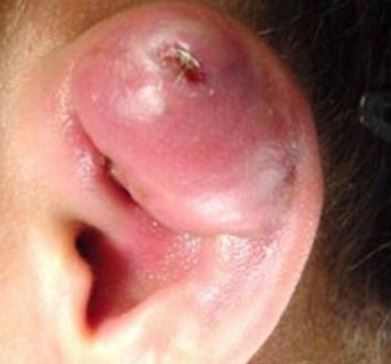 infected-cartilage-piercing-signs