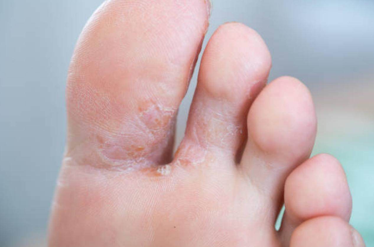 Athlete’s foot causing peeling skin and toes