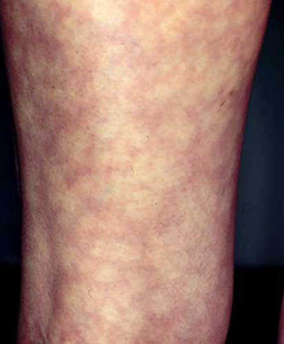 Mottled Skin on legs Causes