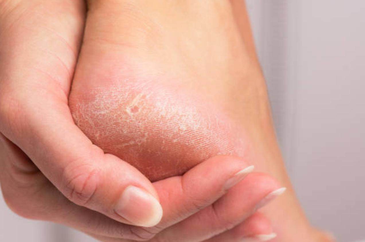 Treatments for skin peeling on toes and feet