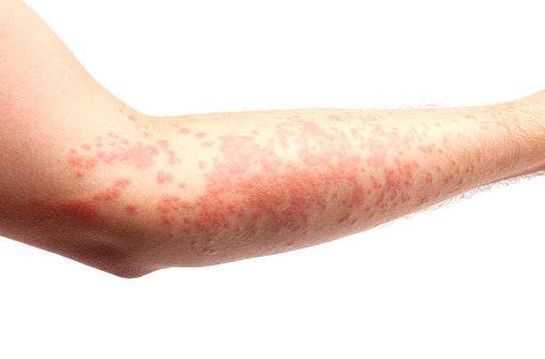 Amoxicillin allergy rash