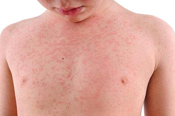 Is rash from amoxicillin itchy