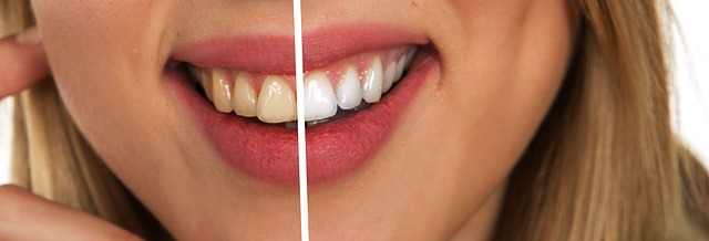 How to use apple cider vinegar for teeth whitening