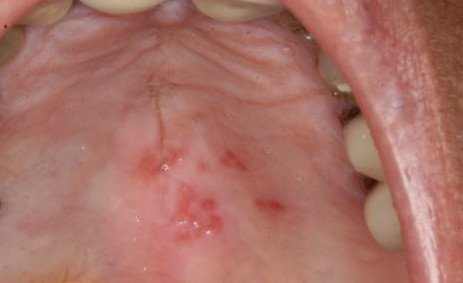 cold sores causing pain on palate 