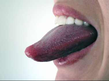 dark purple spot on tongue