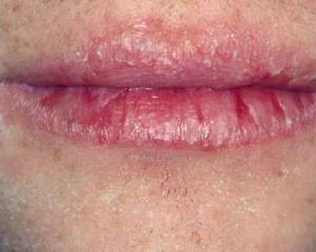 peeling lips herpes