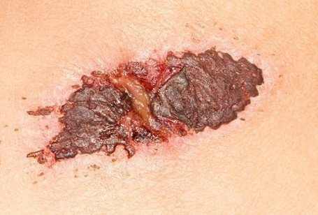 What causes scabs on nipples?