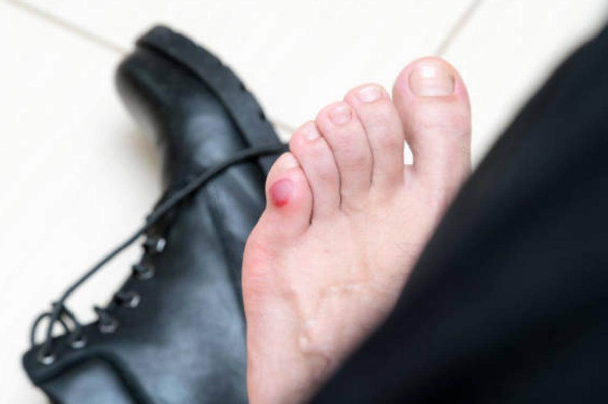 How to pop a blood blister at home