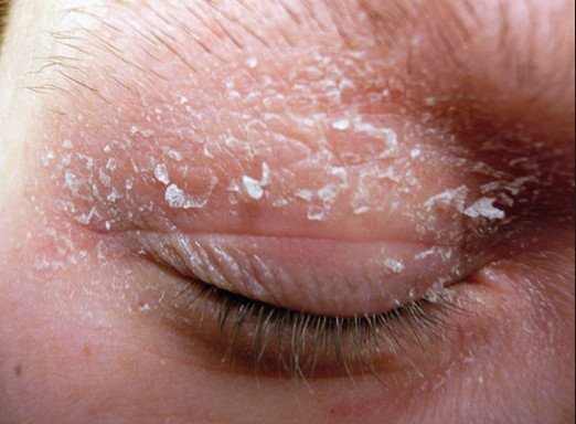Dry skin around eyes and eyelids
