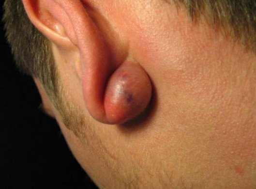 cyst behind ear