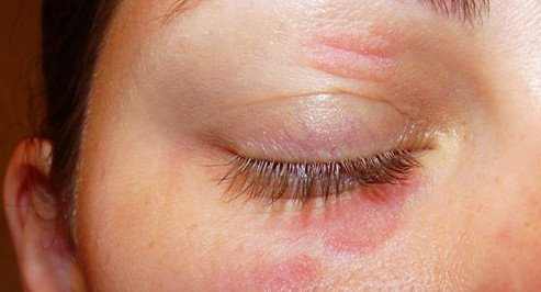 Eyelid dermatitis which refers to localized inflammation of the eyelids