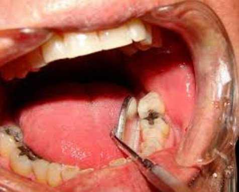 how to remove infected wisdom teeth