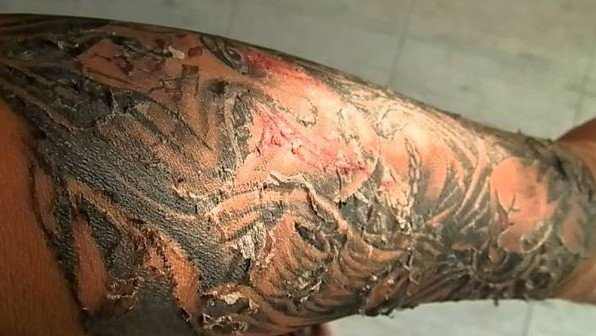 Signs and symptoms of an infected tattoo