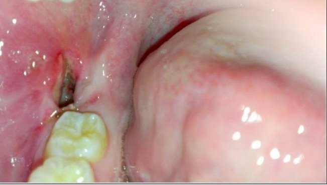 infected wisdom tooth after extraction