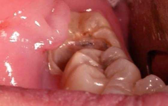 infected wisdom tooth