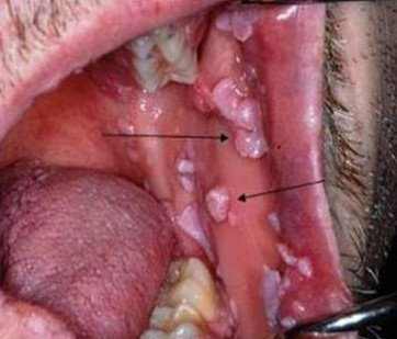 warts inside mouth