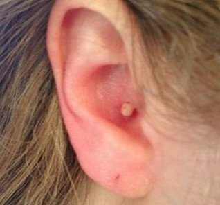 pimple inside ear