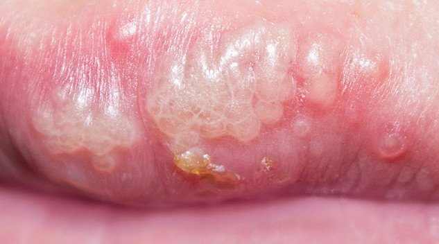 warts inside mouth