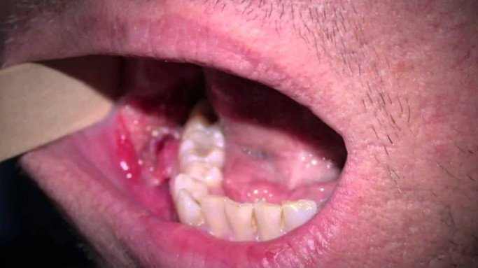 What causes mouth warts