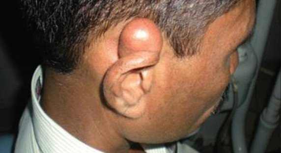 cyst on earlobe