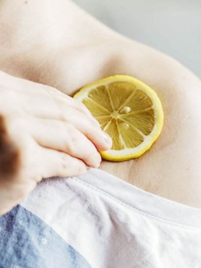 Applying fresh lemon juice to the bites is another way to get rid of the bites fast