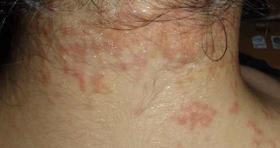 rash on back of neck