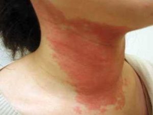 Rash on Neck - Causes and Treatment