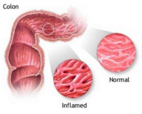 Symptoms of swollen colon