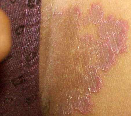 Jock itch or tinea cruris is a common fungal infection that affects the skin around the genital, inner thigh and buttocks