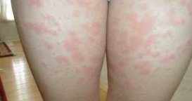 The appearance or an itchy rash will vary depending on what the underlying cause is