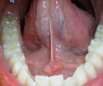 swollen gland under tongue causes, treatment