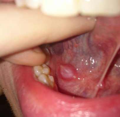 swollen gland one side of tongue