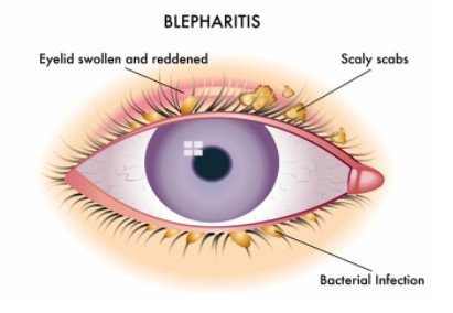 Crusty Eyes, Adults, Newborns, Causes, Symptoms, Treatment