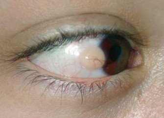Lumps and bump on eyeball is a common eye problem